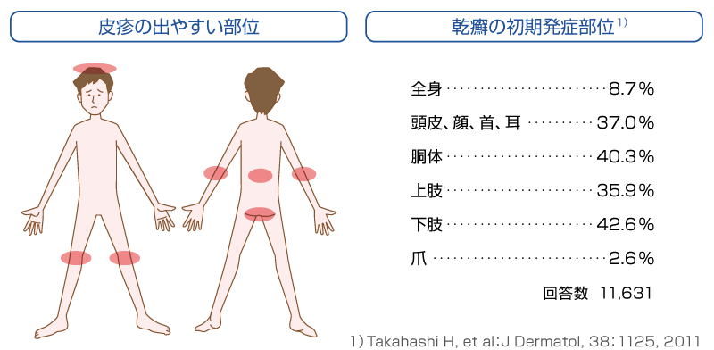 皮疹は頭皮や髪の生え際、肘、膝、腰のまわりに現れやすい。乾癬の初期発症部位は頭が30%、肘・膝が20%、その他（お尻、臍、太もも、爪、すね、下肢等）が30%となっている。