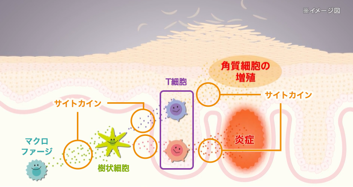 乾癬でみられる免疫機能の異常