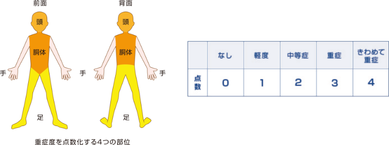 PASI(Psoriasis Area Severity Index):全身を頭・胴体・手・足の4つの部位に分け、どの部分に、どのくらいの大きさの、どの程度の皮疹があるかを調べることで、全身の重症度を点数化します。治療の効果を表す点数はなし（0点）から極めて重症（4点）まであります。