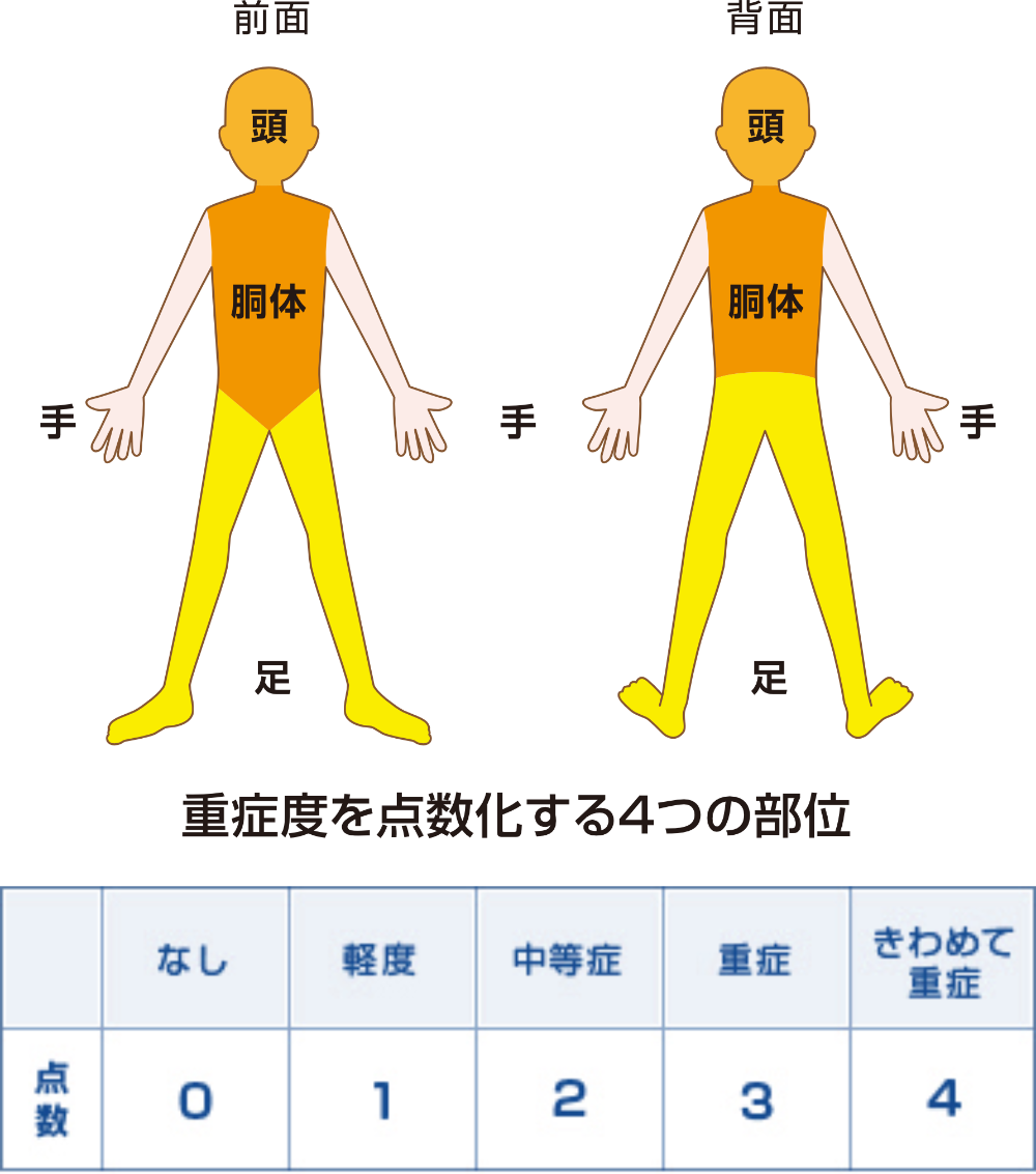 PASI(Psoriasis Area Severity Index):全身を頭・胴体・手・足の4つの部位に分け、どの部分に、どのくらいの大きさの、どの程度の皮疹があるかを調べることで、全身の重症度を点数化します。治療の効果を表す点数はなし（0点）から極めて重症（4点）まであります。
