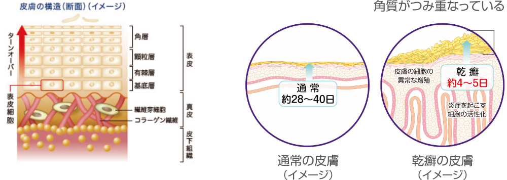 皮膚のターンオーバー周期が通常28日～40日であるのに対し、乾癬患者さんのターンオーバー周期は4～5日となり、角質が積み重なります。