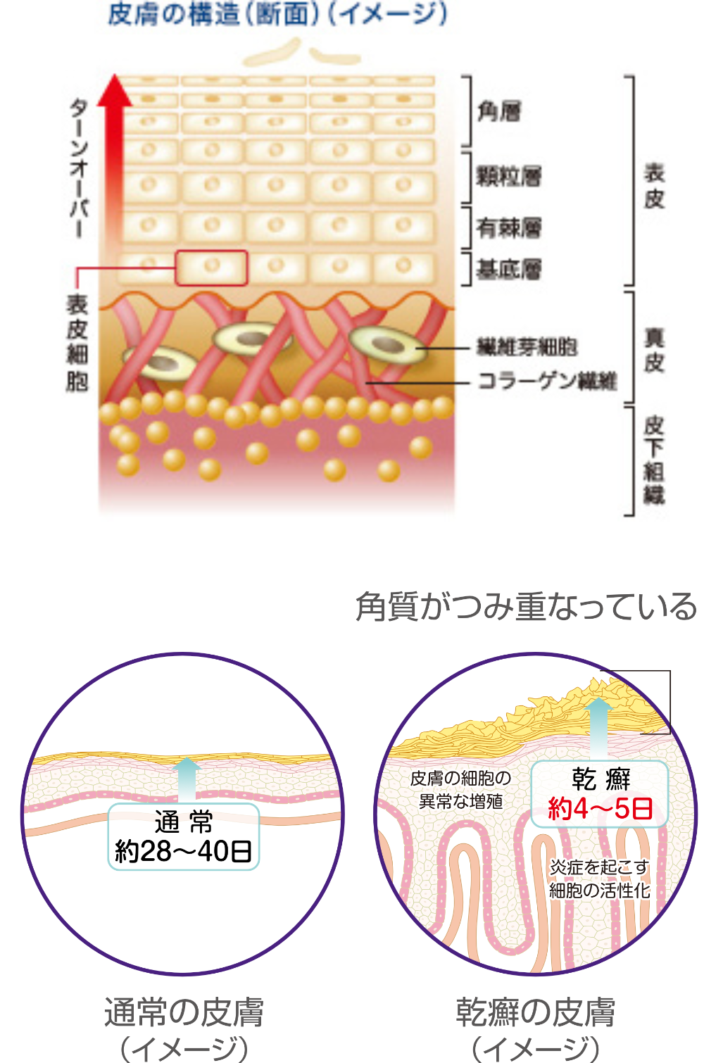 皮膚のターンオーバー周期が通常28日～40日であるのに対し、乾癬患者さんのターンオーバー周期は4～5日となり、角質が積み重なります。