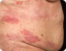 汎発性膿疱性乾癬の紅斑と膿疱の症状