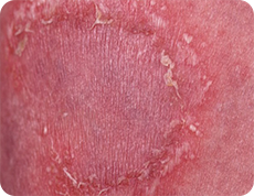 汎発性膿疱性乾癬の膿疱が癒合した膿海の症状