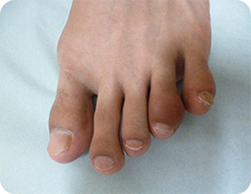 乾癬性関節炎の足関節の腫れの症状