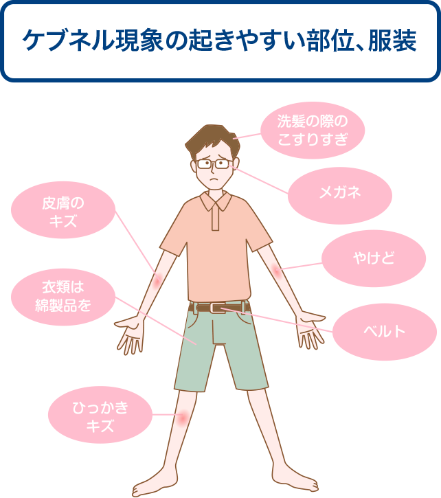 ケブネル現象は、洗髪の際のこすりすぎ・めがね・やけど・皮膚のキズ・引っかきキズ・ベルト等の影響で生じやすくなります。衣類はなるべく綿製品にしましょう。