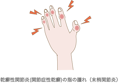 乾癬性関節炎(関節症性乾癬)の指の腫れ（末梢関節炎）
