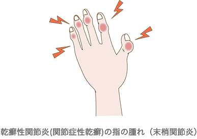 乾癬性関節炎(関節症性乾癬)の指の腫れ(末梢関節炎)