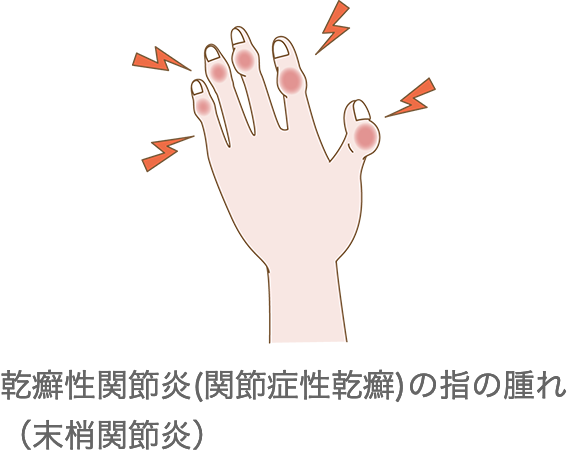 乾癬性関節炎(関節症性乾癬)の指の腫れ（末梢関節炎）