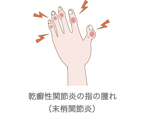 乾癬性関節炎に関するよくある質問