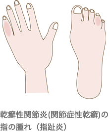 乾癬性関節炎（関節症性乾癬）の指の腫れ（指趾炎）
