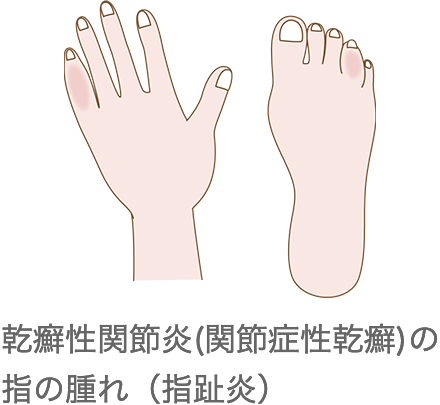 乾癬性関節炎（関節症性乾癬）の指の腫れ（指趾炎）